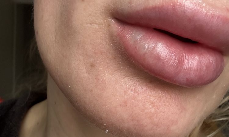 Weiß-blaue Lippe nach Lippen aufspritzen nach 2 Wochen - 73532