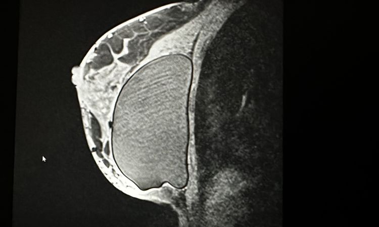 Implantate runtergerutscht? - 73617