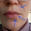 Laser für Lippen Randangion