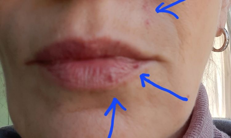 Laser für Lippen Randangion - 73679