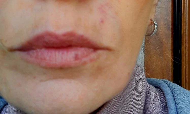 Laser für Lippen Randangion - 73680