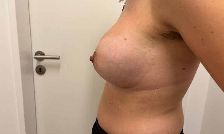 Form der rechten Brust normal ? - 73730
