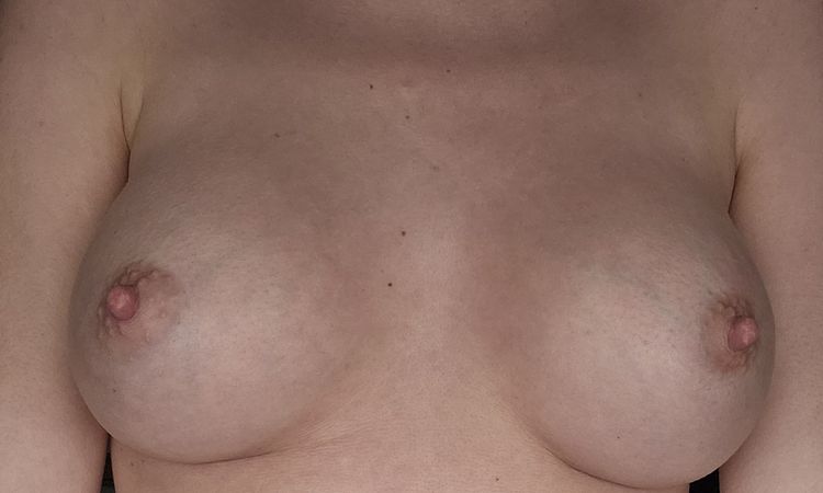 Asymmetrie 4 Monate nach Brustvergrößerung - 73813