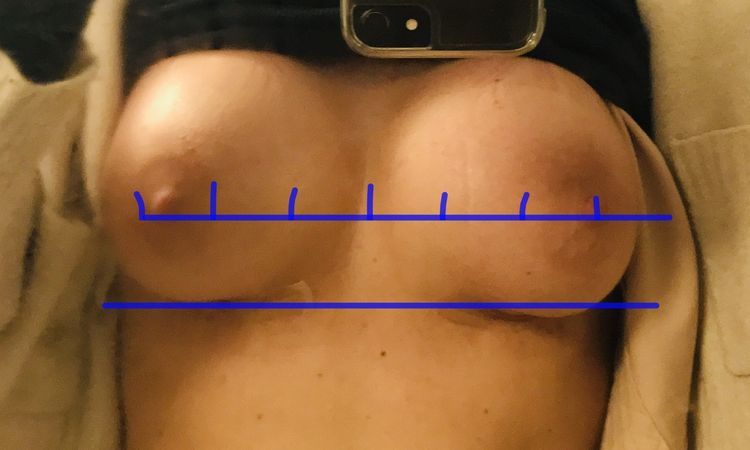 Asymmetrie und tiefsitzende Brustwarzen 5 Wochen nach BV - 73872