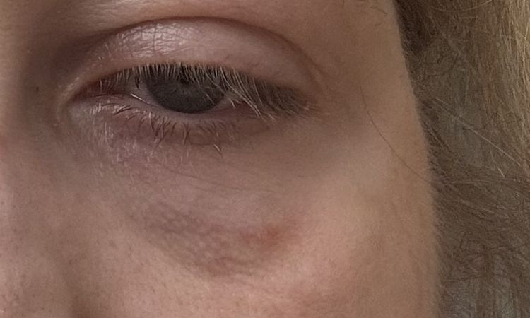 8 Tage nach Hyaluron unterspritzung mit Juvederm immer noch Hügel und Dellen… - 73980