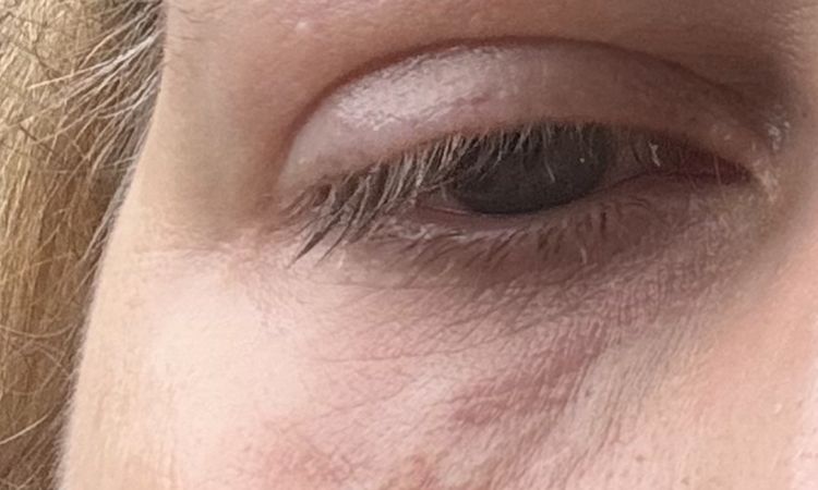 8 Tage nach Hyaluron unterspritzung mit Juvederm immer noch Hügel und Dellen… - 73981