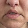 Lippenlifting - offener Mund