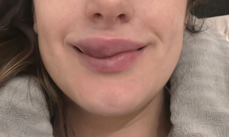 Extreme Schwellung nach Lippenaufspritzung mit Hyaluron - 74108