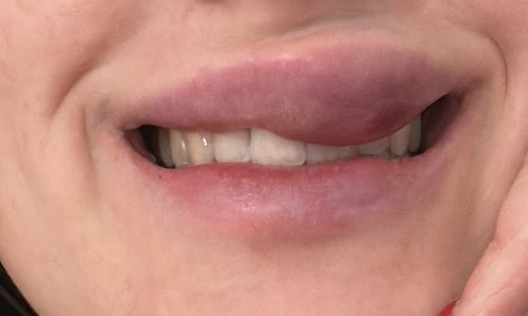 Extreme Schwellung nach Lippenaufspritzung mit Hyaluron - 74109