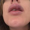 Extreme Schwellung nach Lippenaufspritzung mit Hyaluron