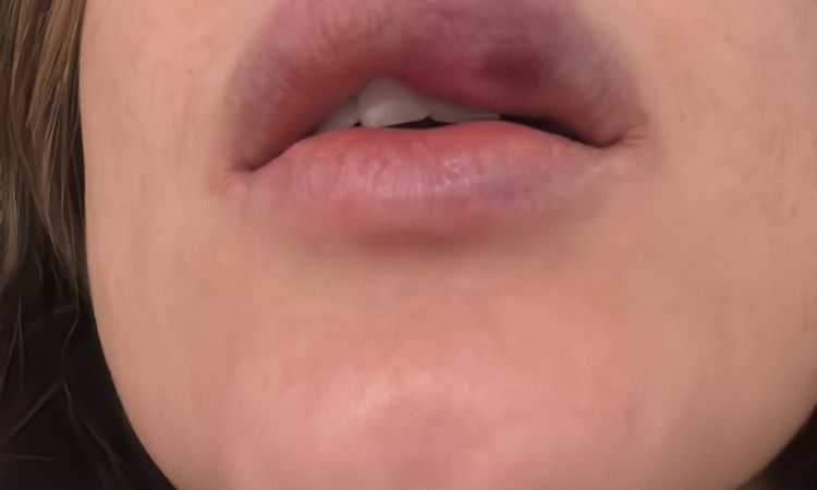 Extreme Schwellung nach Lippenaufspritzung mit Hyaluron - 74110