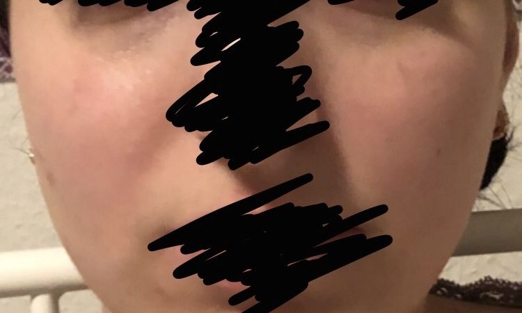 Buccal fat removal Oder Botox ? - 74178
