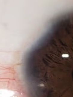 Blepharoplastik nach 3M - Augen schließen nicht mehr - 74186