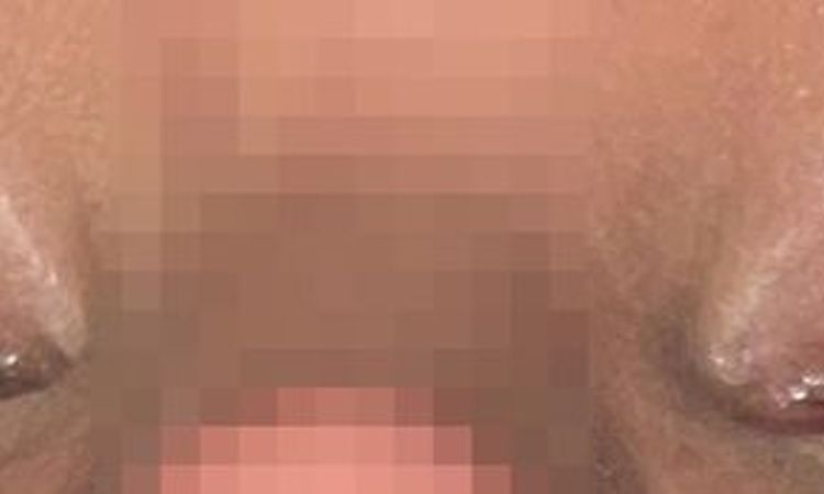 Blepharoplastik - Lidschluss nach 3M - unerwünschtes Ergebnis - 74198