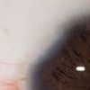 Blepharoplastik - Lidschluss nach 3M - unerwünschtes Ergebnis - 74199