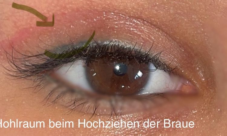 Blepharoplastik - Lidschluss nach 3M - unerwünschtes Ergebnis - 74200