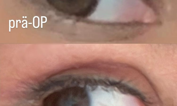 Blepharoplastik - Lidschluss nach 3M - unerwünschtes Ergebnis - 74202