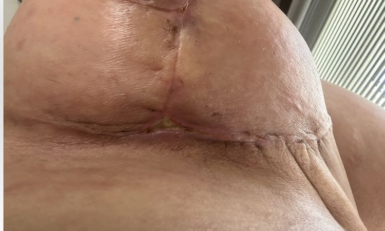 Loch, Eiter oder Fibrin in der Brustfalte nach Bruststraffung - 74421