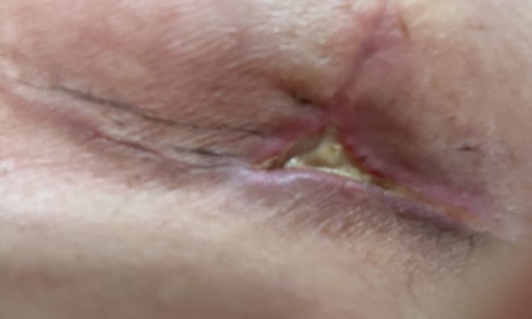 Loch, Eiter oder Fibrin in der Brustfalte nach Bruststraffung - 74423