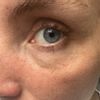 Tränensäcke nach Botoxbehandlung und schwere Augen - 74428