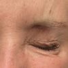 Tränensäcke nach Botoxbehandlung und schwere Augen - 74429