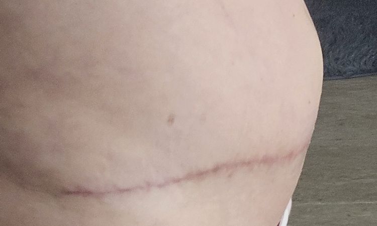 Dicke Bauch nach Bauchdeckenstraffung - 74435