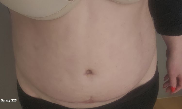 Dicke Bauch nach Bauchdeckenstraffung - 74436