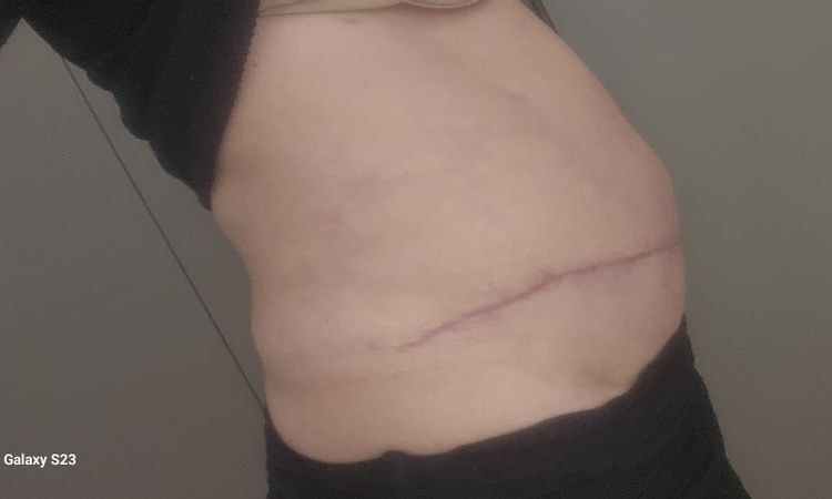 Dicke Bauch nach Bauchdeckenstraffung - 74437