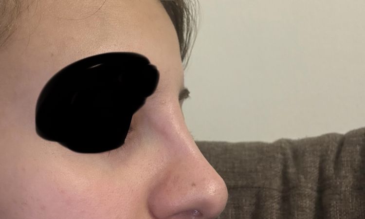 Hylase mit Juvederm Ultra in der Nase auflösen - 74478