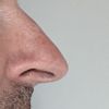 Nach Nasen-Op - leichten Nasenhöcker formen