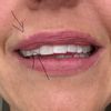 Narbengewebe im Lippengewebe entfernen - 74538
