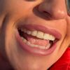 Narbengewebe im Lippengewebe entfernen - 74539