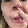 Narbengewebe im Lippengewebe entfernen