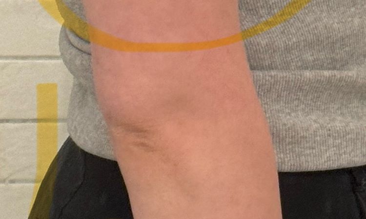 Stand nach Fettabsaugung an Oberarmen nach einem Jahr - 74704