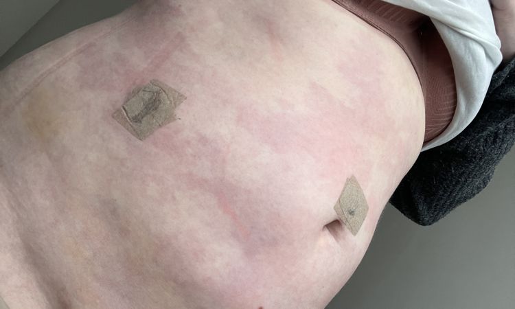 Rote Flecken nach Lipo Bauch - 74717