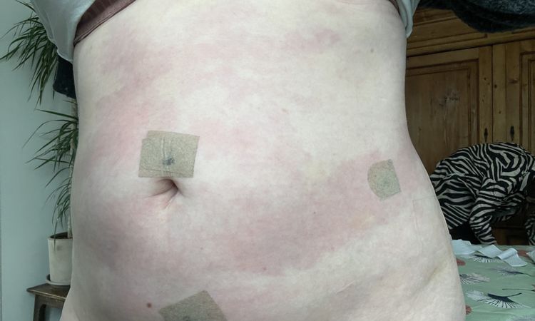 Rote Flecken nach Lipo Bauch - 74718