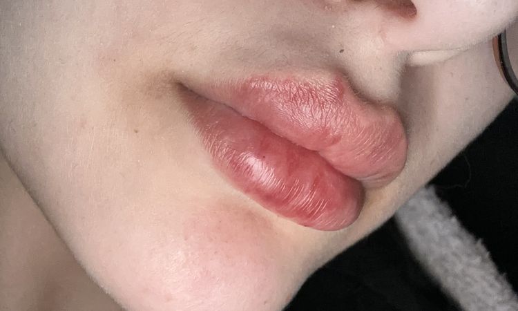 Hilfe! Lippen unterspritzung - 74801