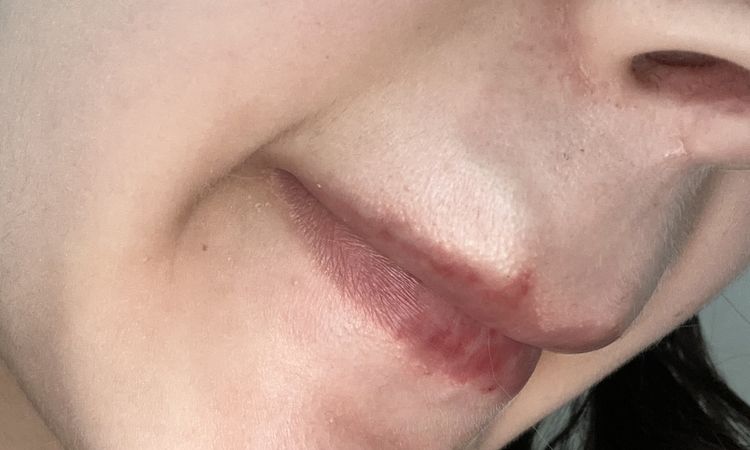 Hilfe! Lippen unterspritzung - 74803