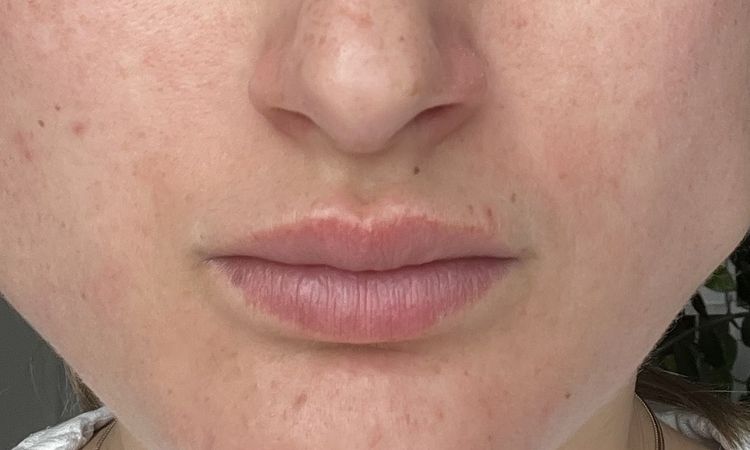 Beule nach Botox Behandlung am Massetermuskel - 74824