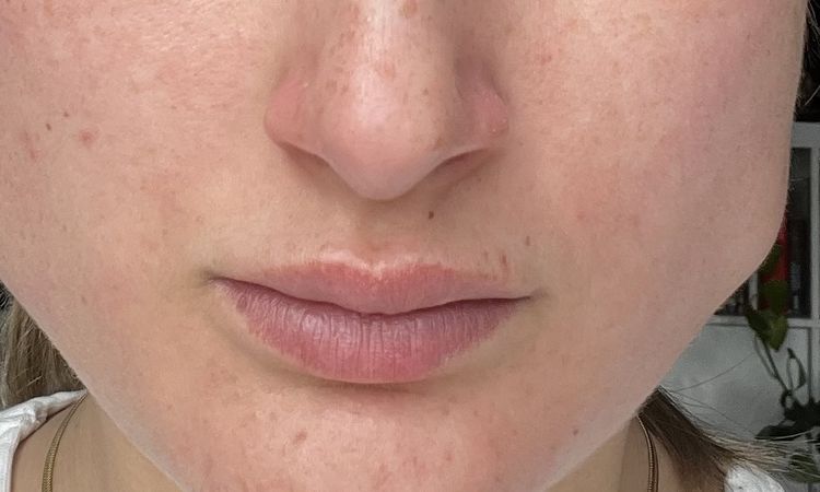 Beule nach Botox Behandlung am Massetermuskel - 74825