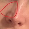 Eine bereits voroperierte Nase mit Hyaluron unterspritzen lassen? - 74879