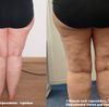 Nach Lipödem-Liposuktion Hautbild wie ein Trümmerfeld