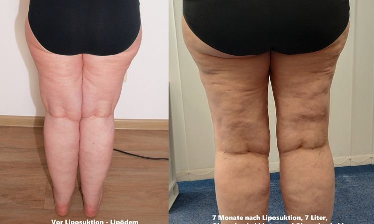 Nach Lipödem-Liposuktion Hautbild wie ein Trümmerfeld - 74886