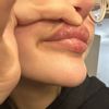 Viele Knoten nach Lippenunterspritzung