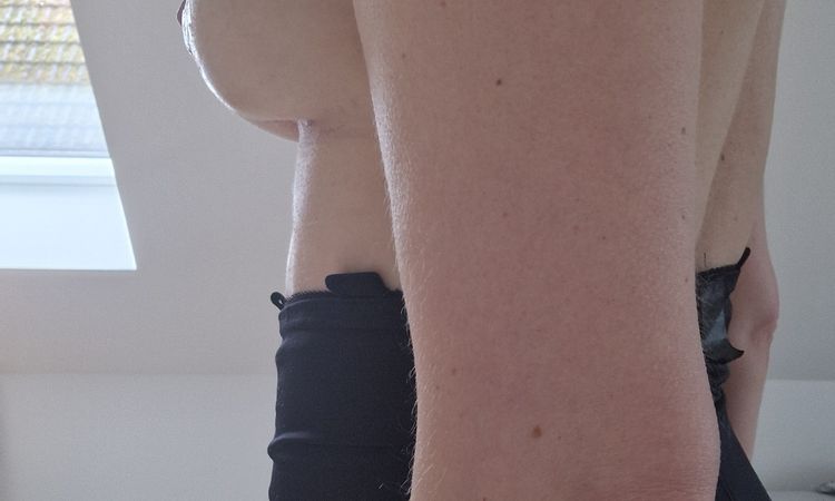 Bruststraffung - Einkerbung an Brustnsatz - 74953