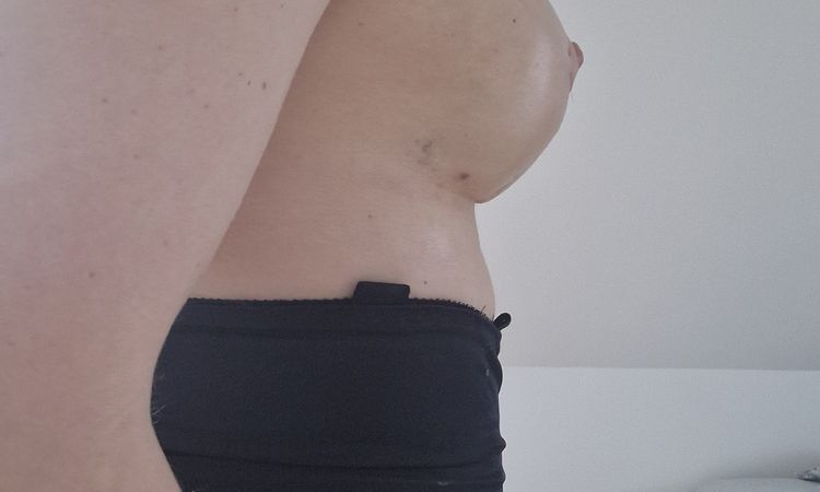 Bruststraffung - Einkerbung an Brustnsatz - 74954