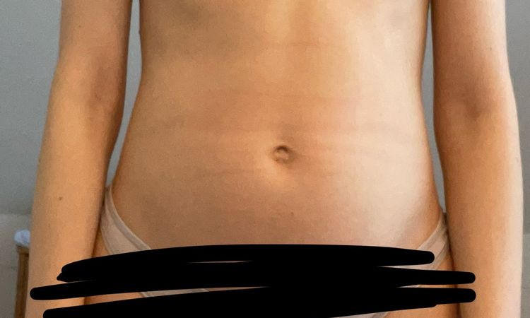Brustvergrößerung mit Eigenfett bei junger schlanker Patientin - 74980