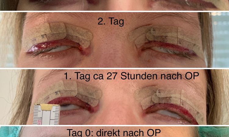 Augen schließen sich nicht nach Augenlidoperation - 75165