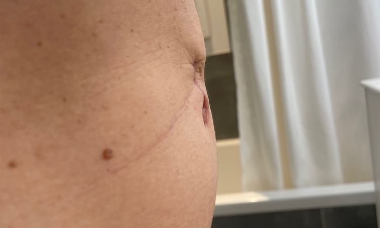 Warum ist die Narbe so nach innen gezogen? Narbenkorrektur schon möglich? - 75190