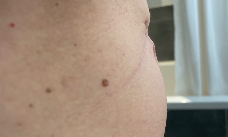 Warum ist die Narbe so nach innen gezogen? Narbenkorrektur schon möglich? - 75191